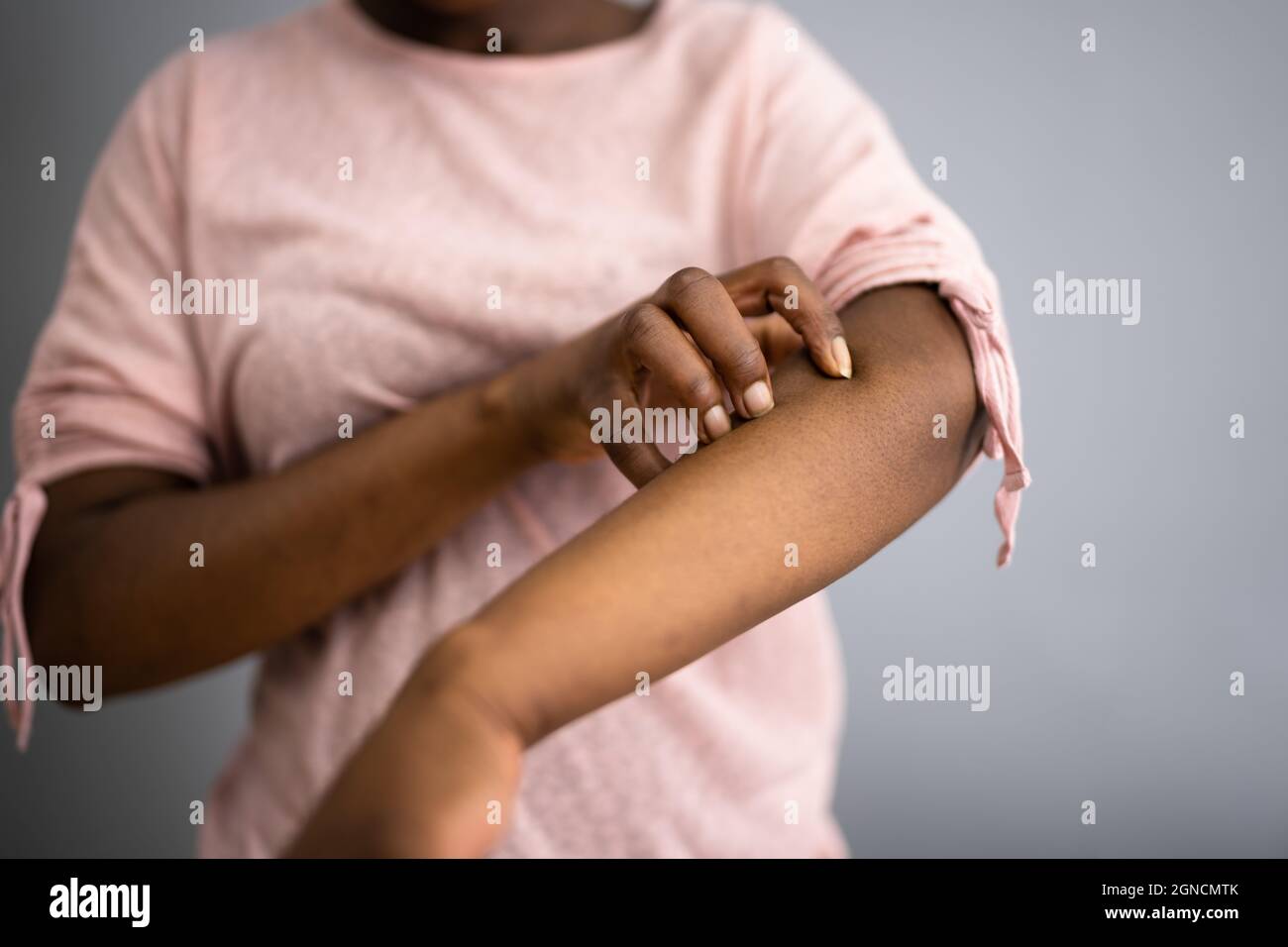 African American Woman With Itchy Skin. Allergy Or Psoriasis Stock Photo