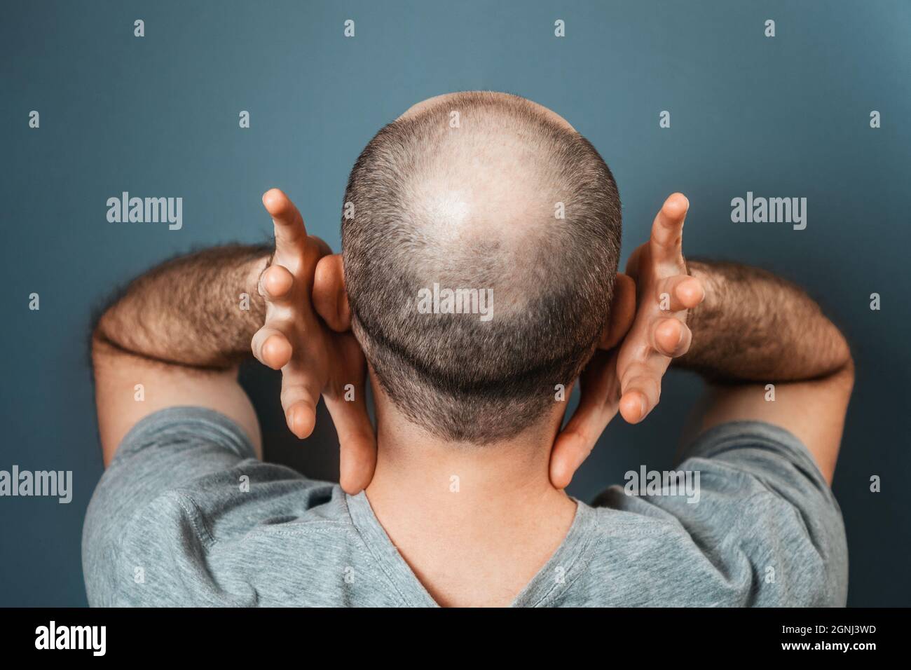 Baldy man suffering because of his appearance. Person grabs his head with his hands. Back view. Turquoise background. The concept of alopecia and bald Stock Photo