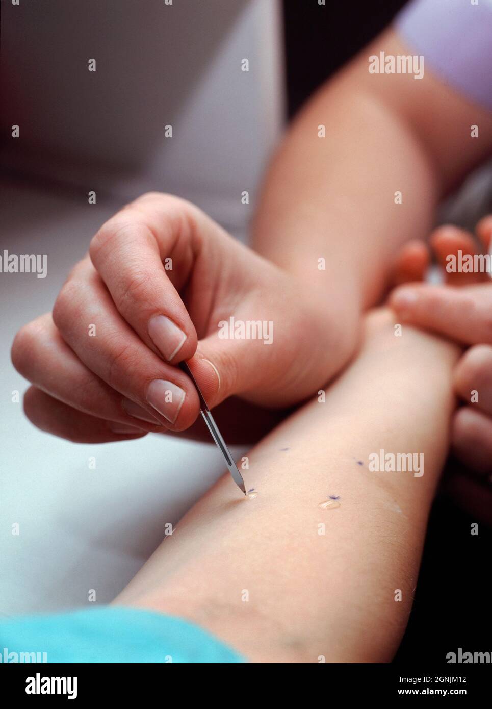 Allergist applies minute amounts of potential allergen extracts to the forearm skin of a young man. Stock Photo