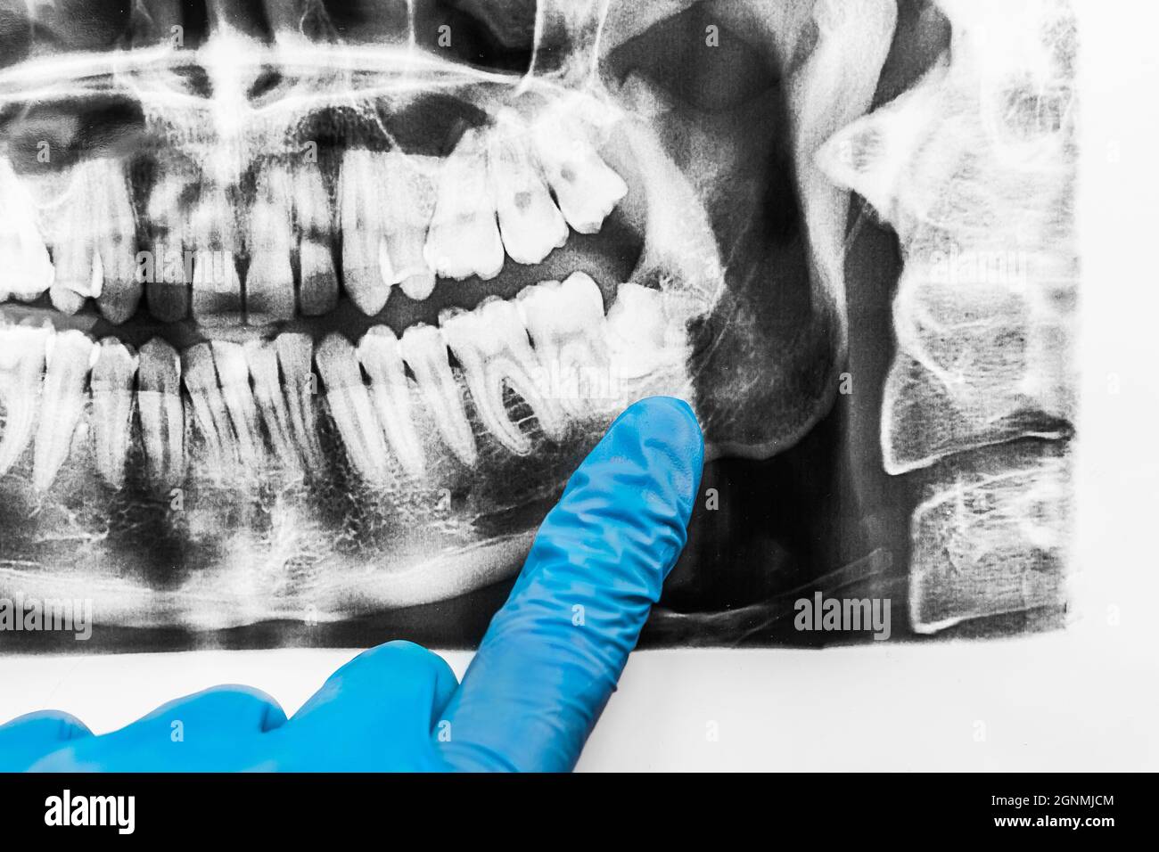 A doctor's hand in a protective medical glove points with a finger at the growth of wisdom teeth in the lower jaw on an X-ray image of the oral cavity Stock Photo