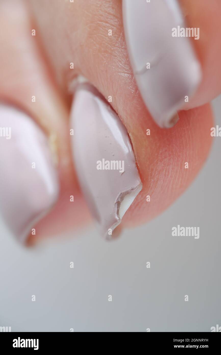 Broken female nails with manicure. Weak and brittle nails Stock Photo