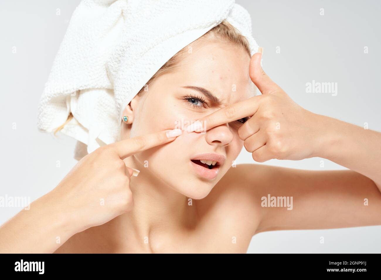 woman with a towel on my head acne on the face dermatology Stock Photo Alamy