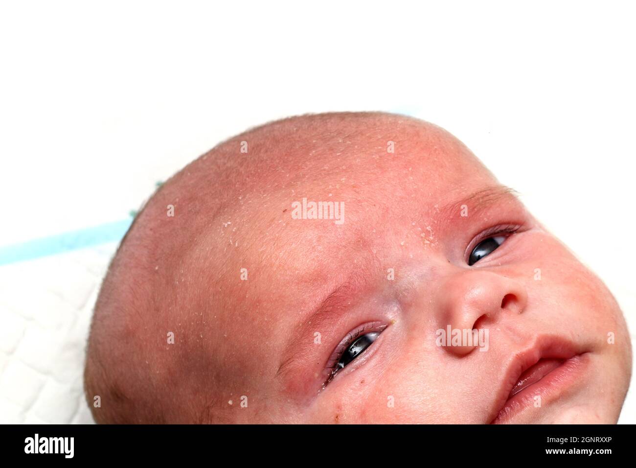 The detail of the head of the unhappy crying newborn baby boy with skin problems. He has seborea and acne. Stock Photo