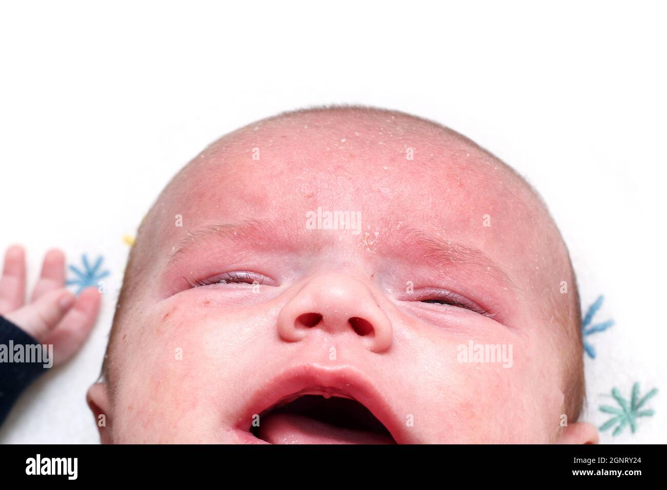 The detail of the head of the unhappy crying newborn baby boy with skin problems. He has seborea and acne. Stock Photo
