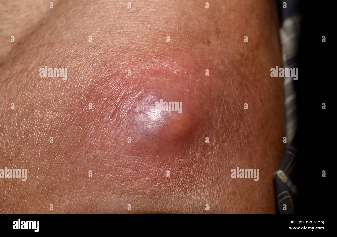Large carbuncle or abscess at trunk of Asian Burmese male patient. Stock Photo