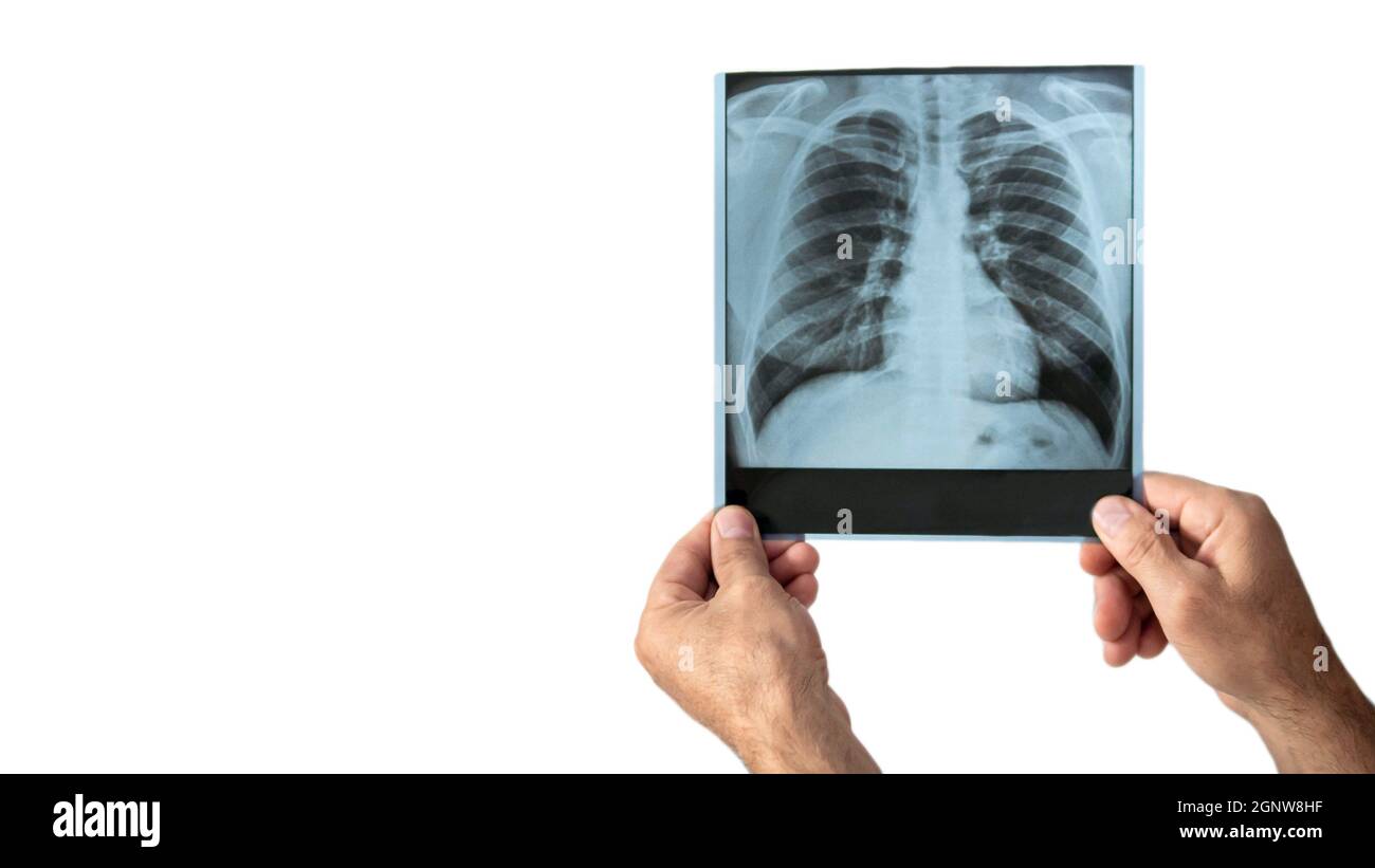 Copy Space Analysis Of Pneumonia Photo The Doctor Looks At The X Ray Of The Lungs In The Clinic The Health Worker Analyzes The Pneumonia Of The Lung Stock Photo Alamy
