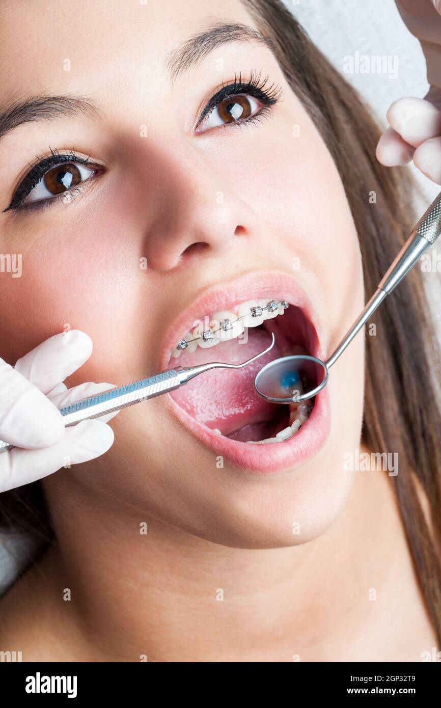 Extreme macro close up of open human mouth showing stainless steel braces. Stock Photo