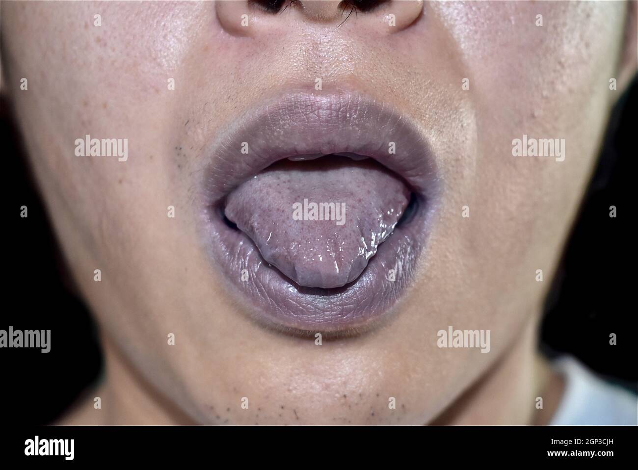 Cyanotic lips or central cyanosis at Southeast Asian young man with congenital heart disease. Stock Photo