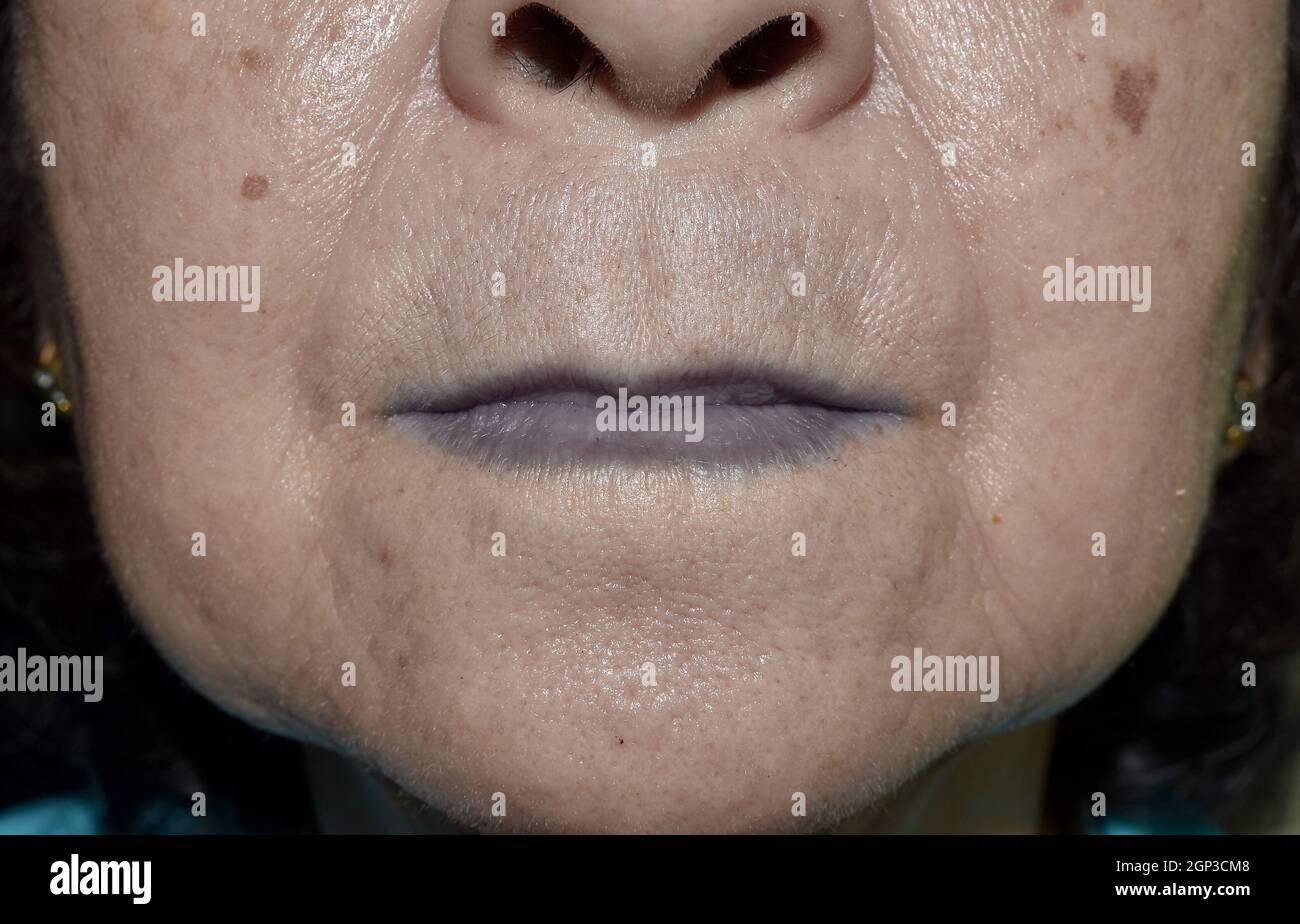 Cyanotic lips or central cyanosis at Southeast Asian old woman with congenital heart disease. Stock Photo