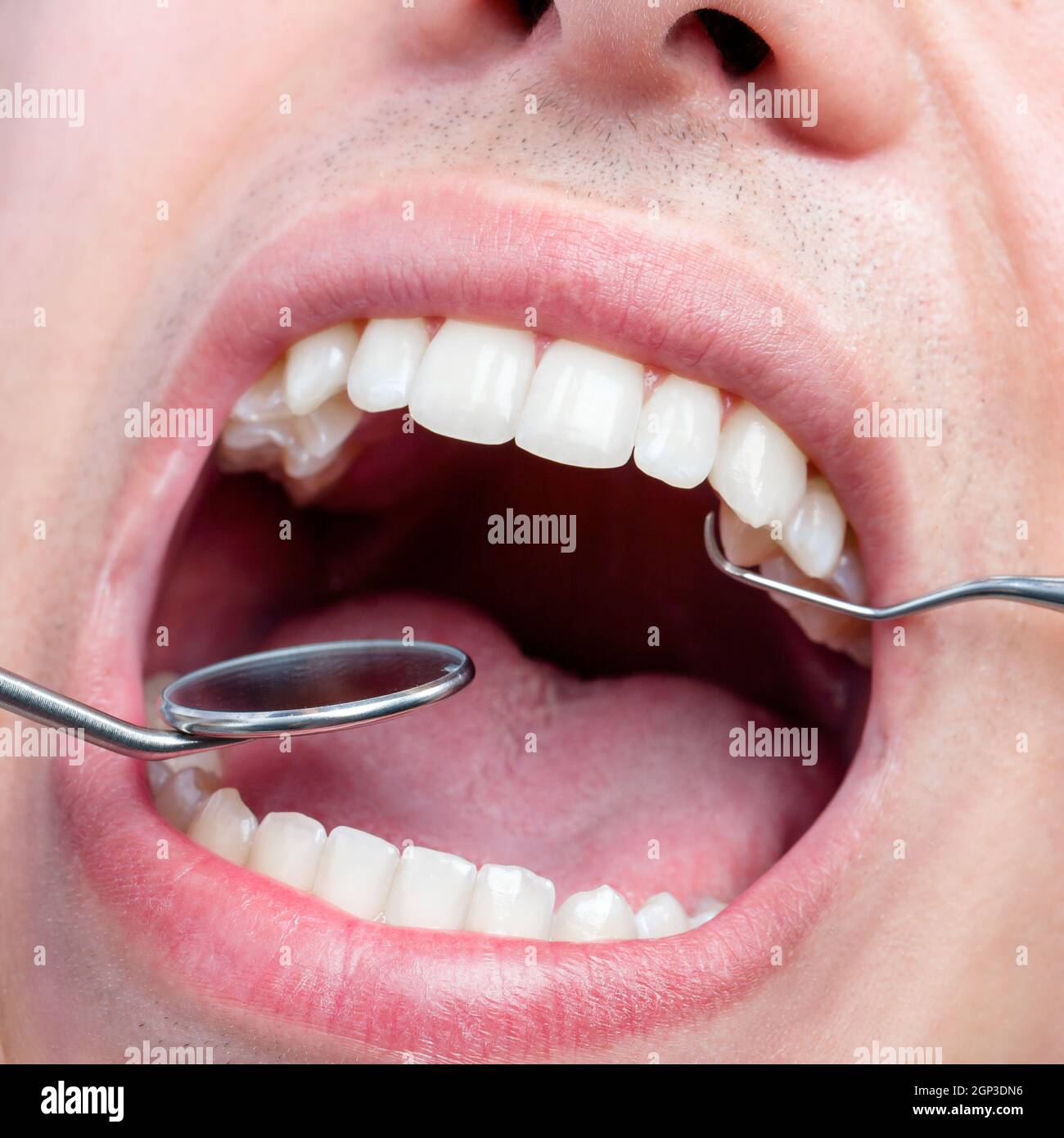 Extreme close up of Human male mouth showing teeth with dental hatchet and mouth mirror. Stock Photo