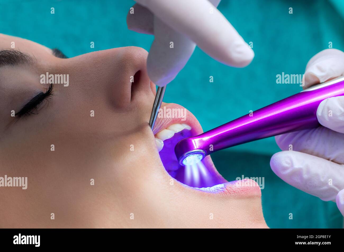 Macro close up of hand working on female teeth with blue led curing light. Stock Photo