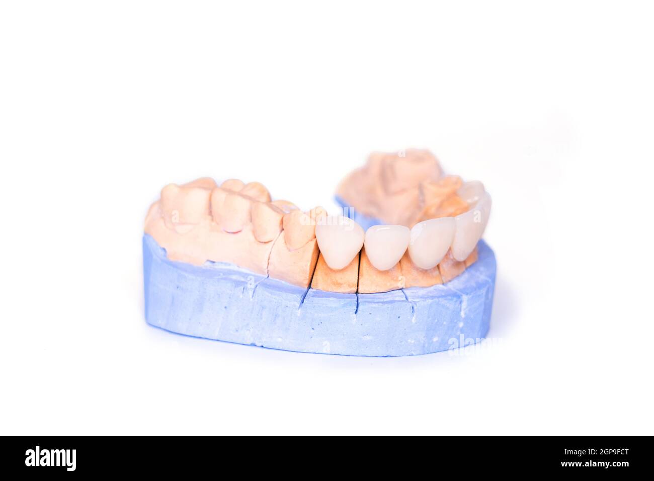Veneers and crowns isolated on white background. Plaster model of teeth. lower jaw plaster model with prepared teeth. White front teeth veneers on Stock Photo