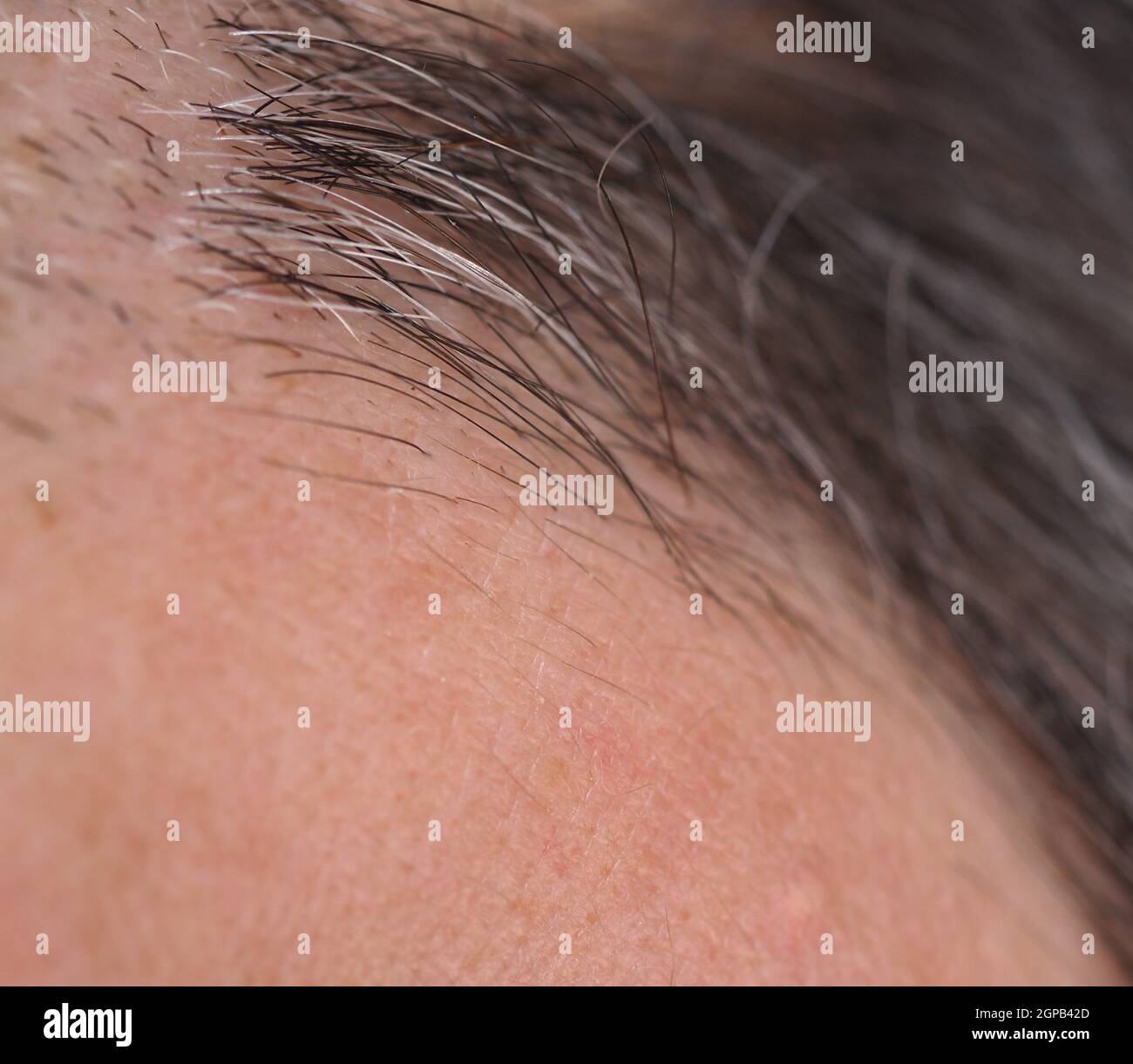 detail of hair follicle anchoring hairs to head skin Stock Photo Alamy