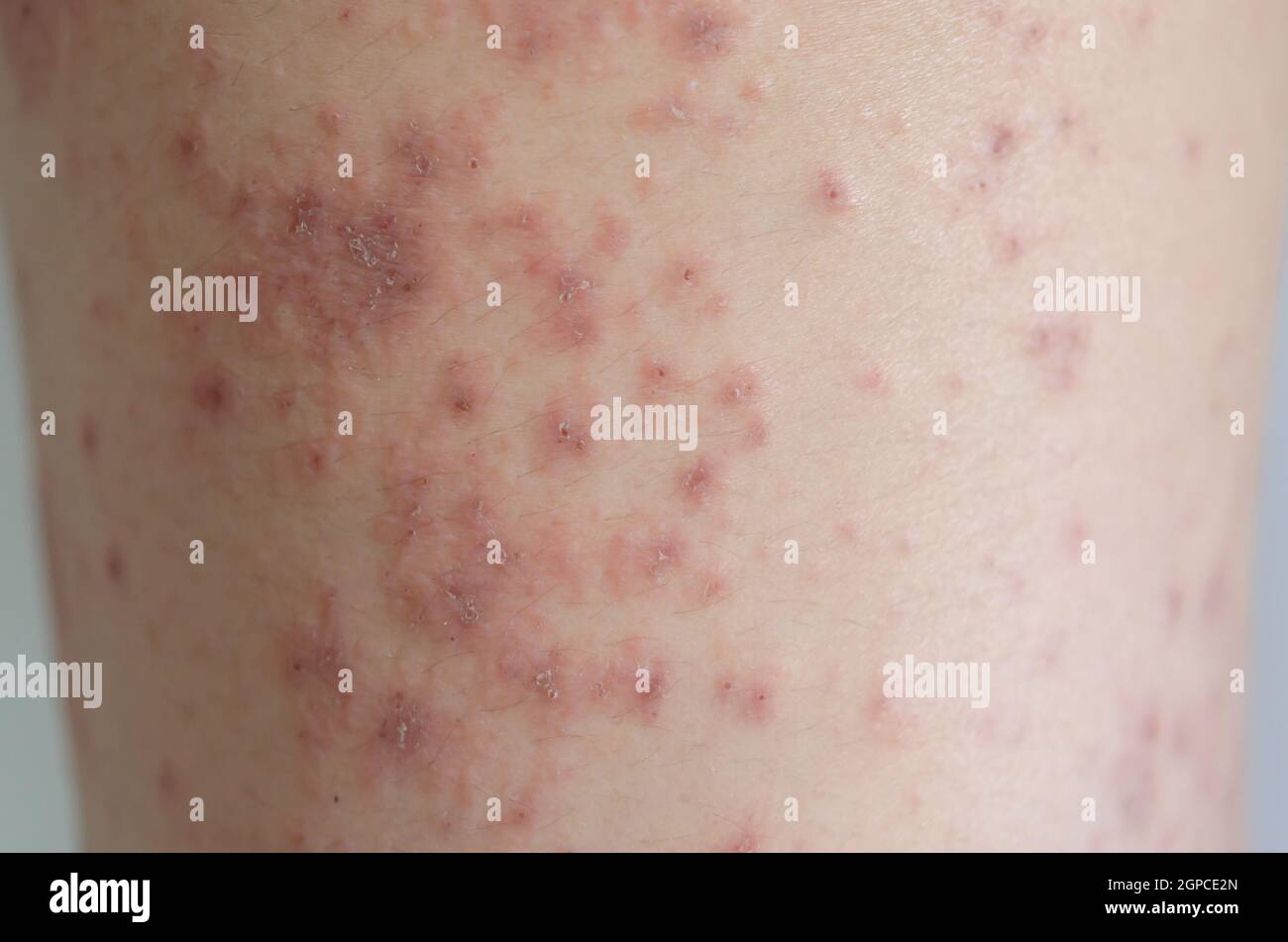 Closeup of skin rashes caused by allergies. Rashes are caused by food