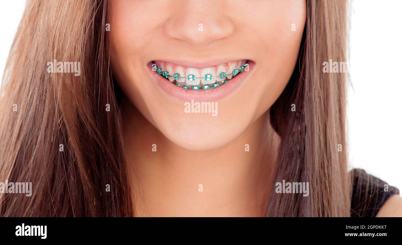 Attractive young woman with brackets isolated on a white backgroung Stock Photo