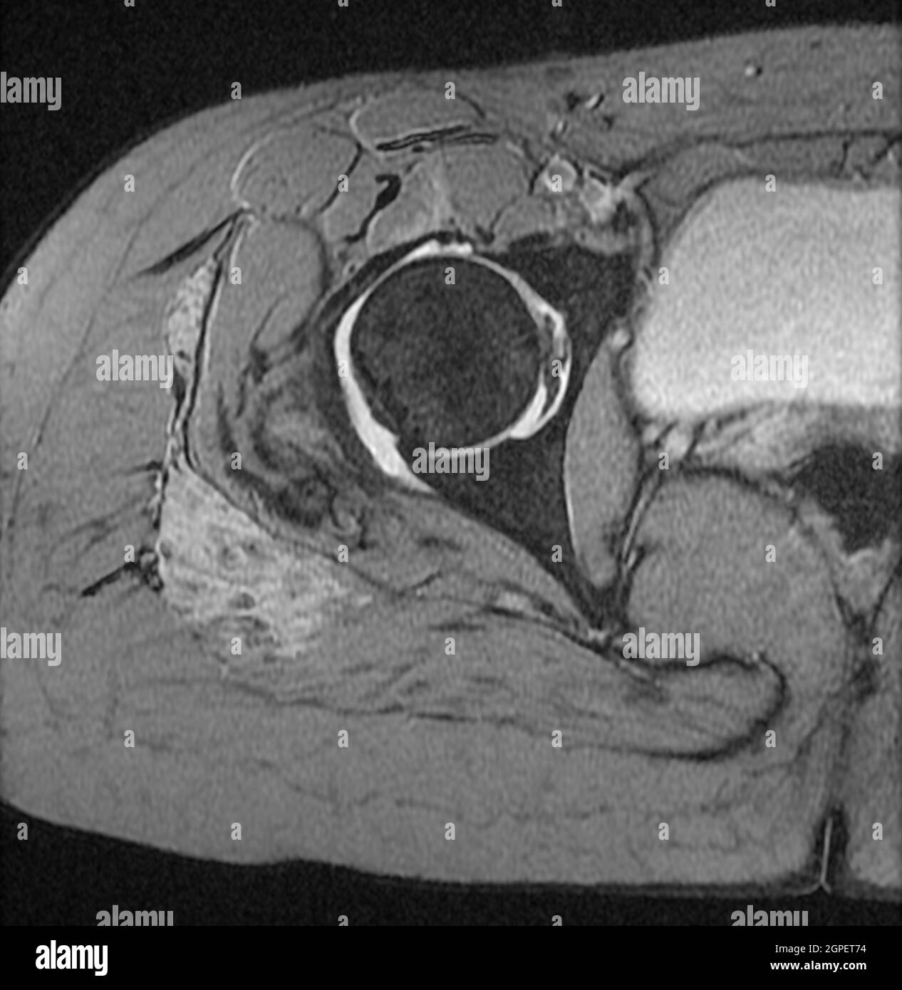 MRI of 20 year old female hip with signs of Hemangioma on upper right thigh. Stock Photo