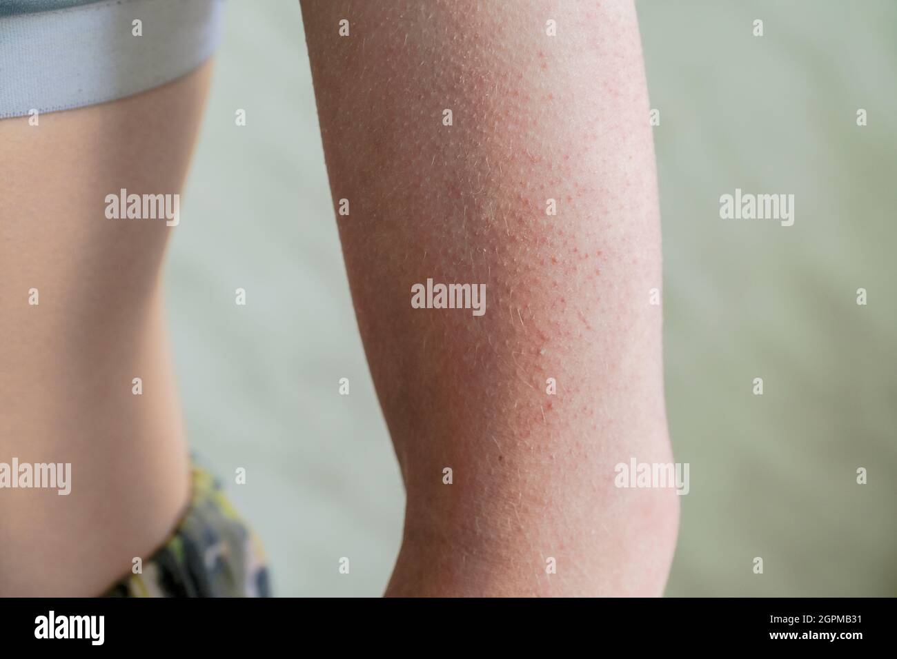 follicular hyperkeratosis is located on the person's arm. Stock Photo