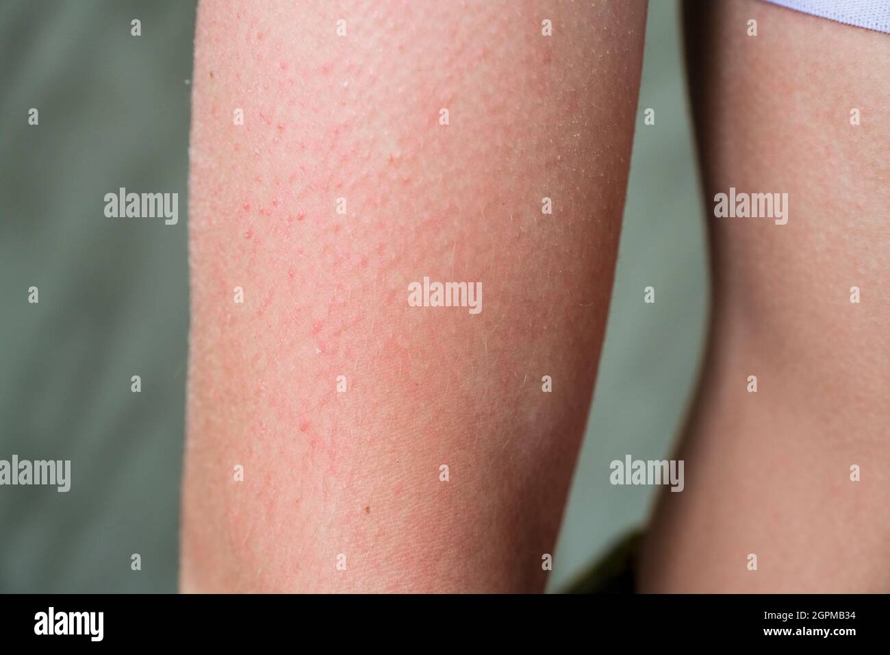 follicular hyperkeratosis is located on the person's arm. Stock Photo