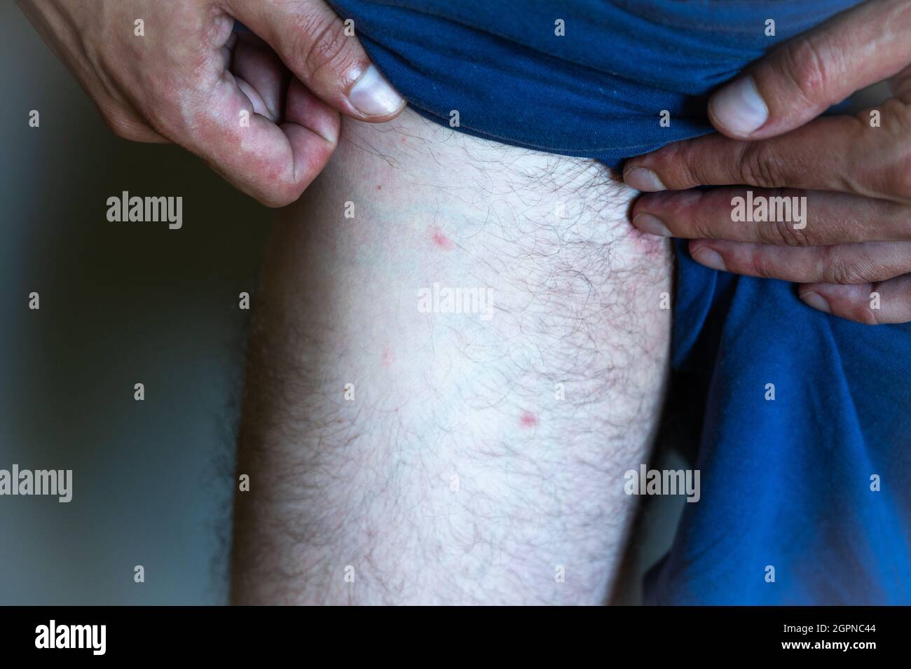 A rash on a man's leg near the intimate area. Man with symptoms of itchy urticaria. Stock Photo