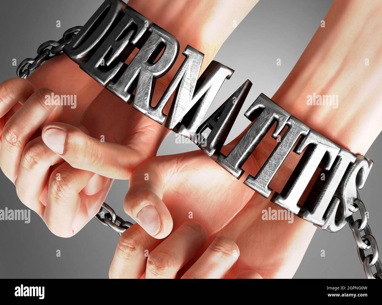 Social impact and influence of dermatitis - analogy showing human hands in chains with a word dermatitis as a symbol of its burden and misery it bring Stock Photo