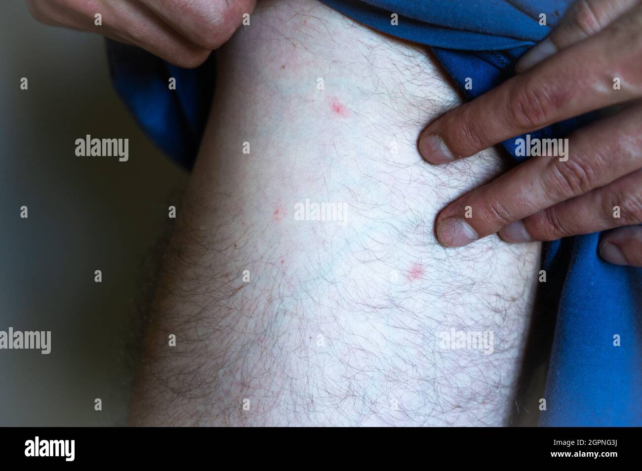 A rash on a man's leg near the intimate area. Man with symptoms of itchy urticaria. Stock Photo