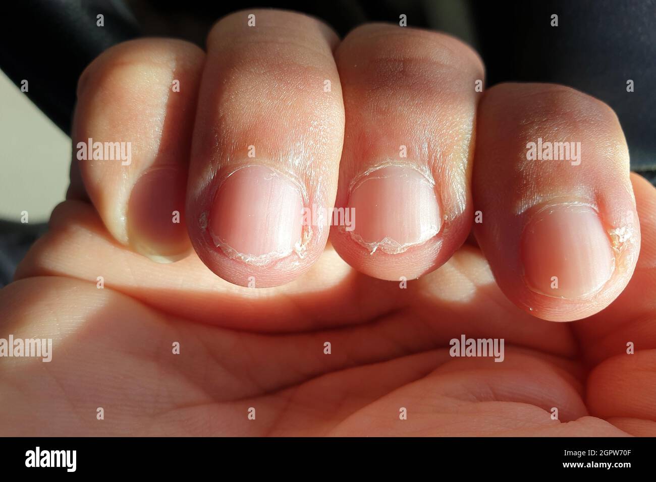 Torn Off A Fingernail Stock Photo Alamy