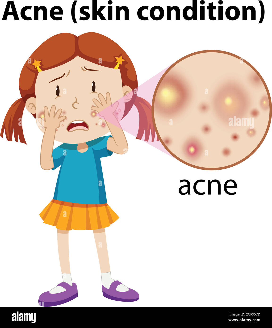 A Young Girl Having Acne Stock Vector