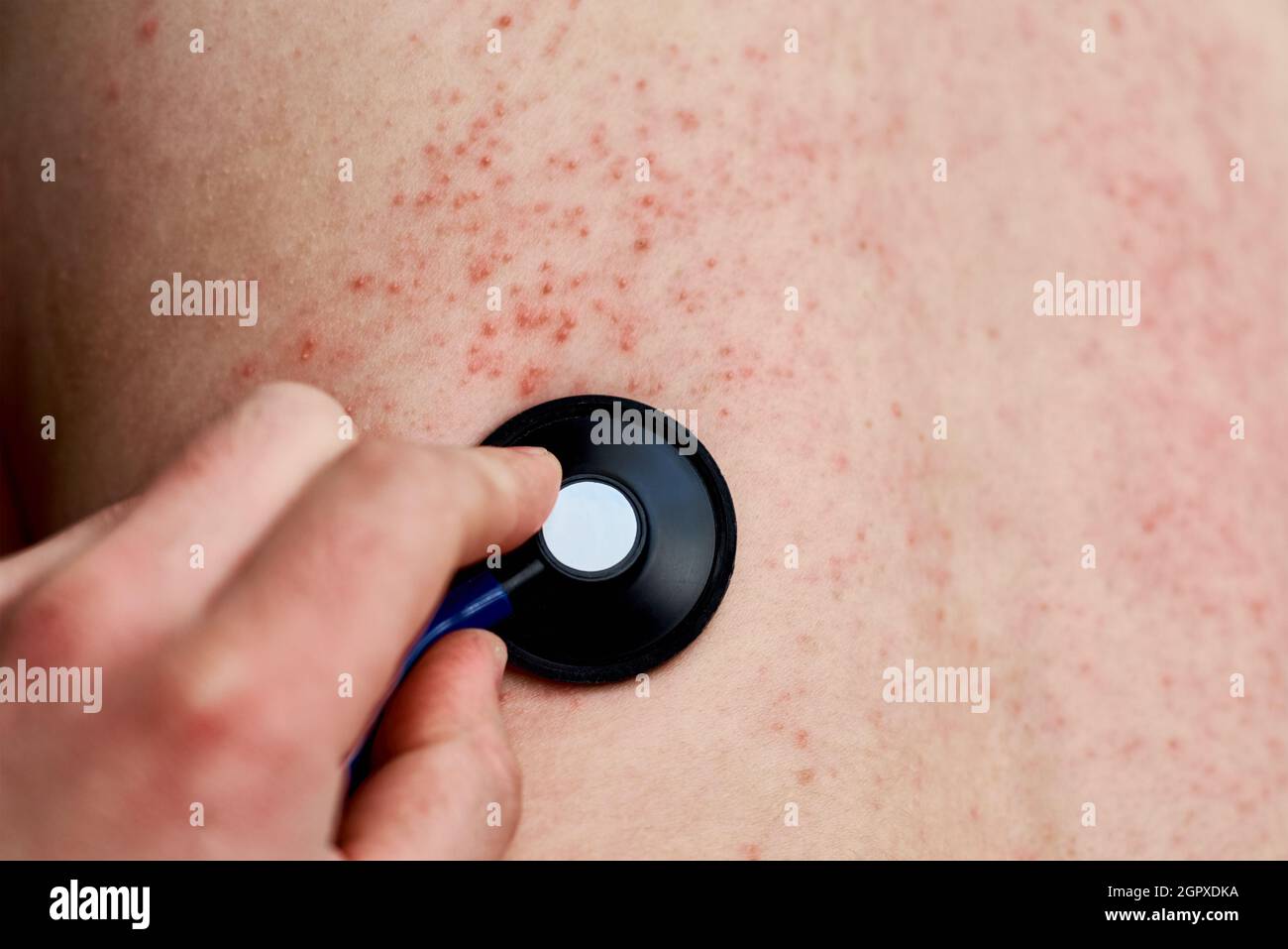 Skin Rash Back High Resolution Stock Photography and Images Alamy