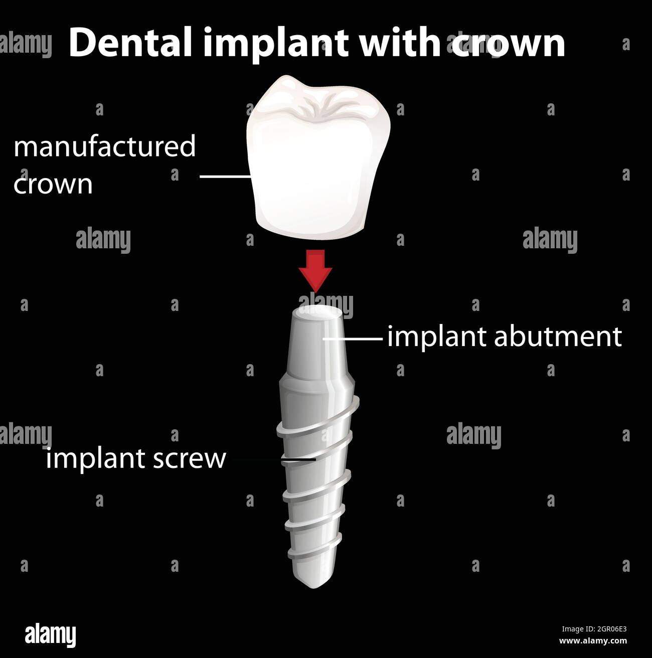 A dental implant with crown Stock Vector