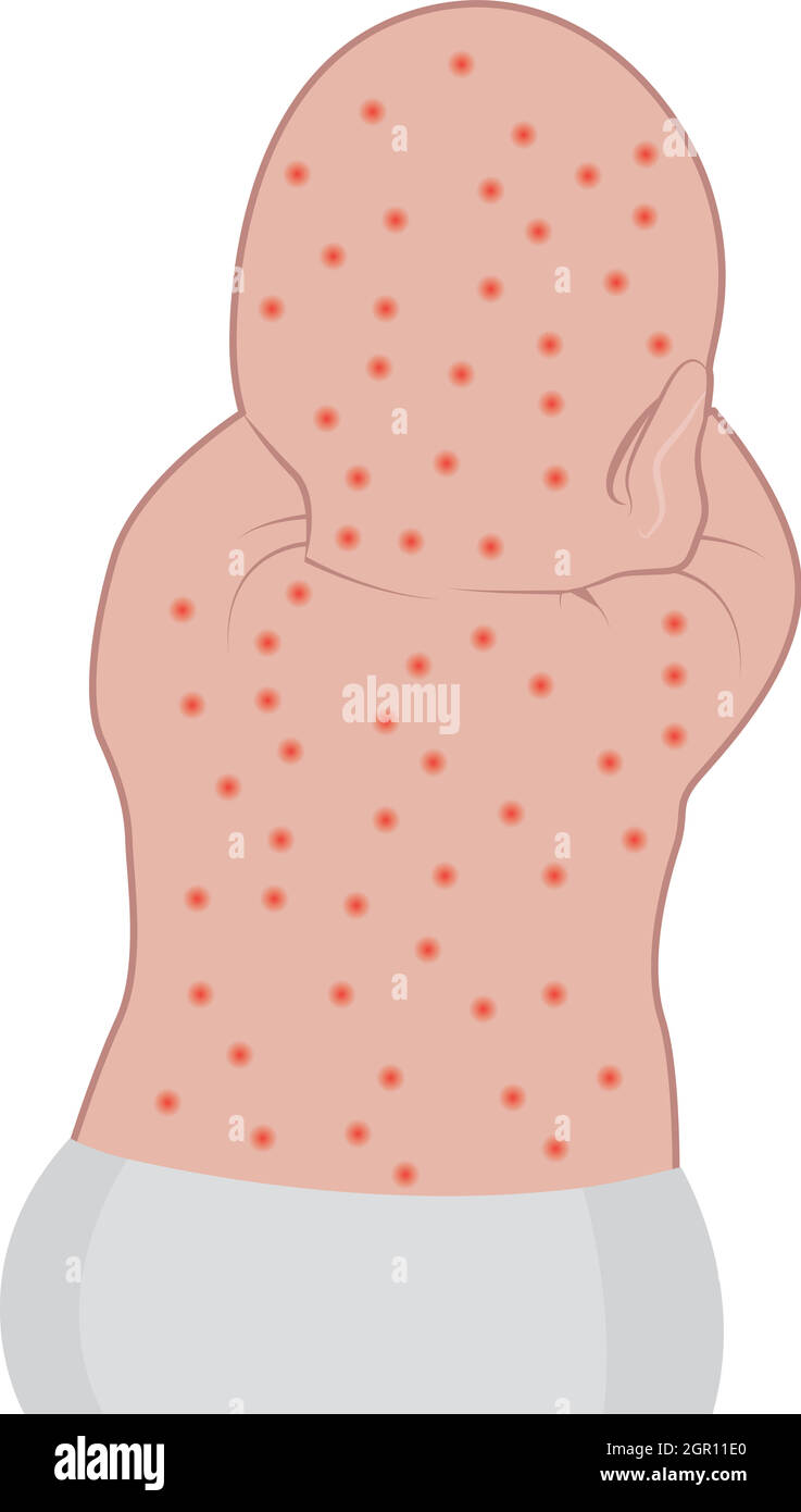 Baby's back affected with eczema skin Stock Vector Image & Art - Alamy