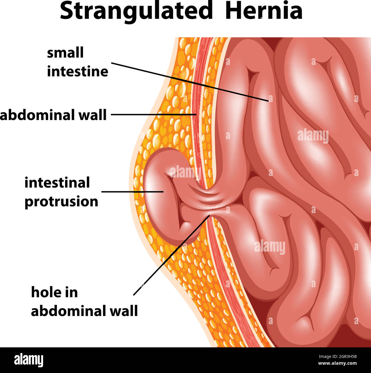 Strangulated Hernia Stock Vector