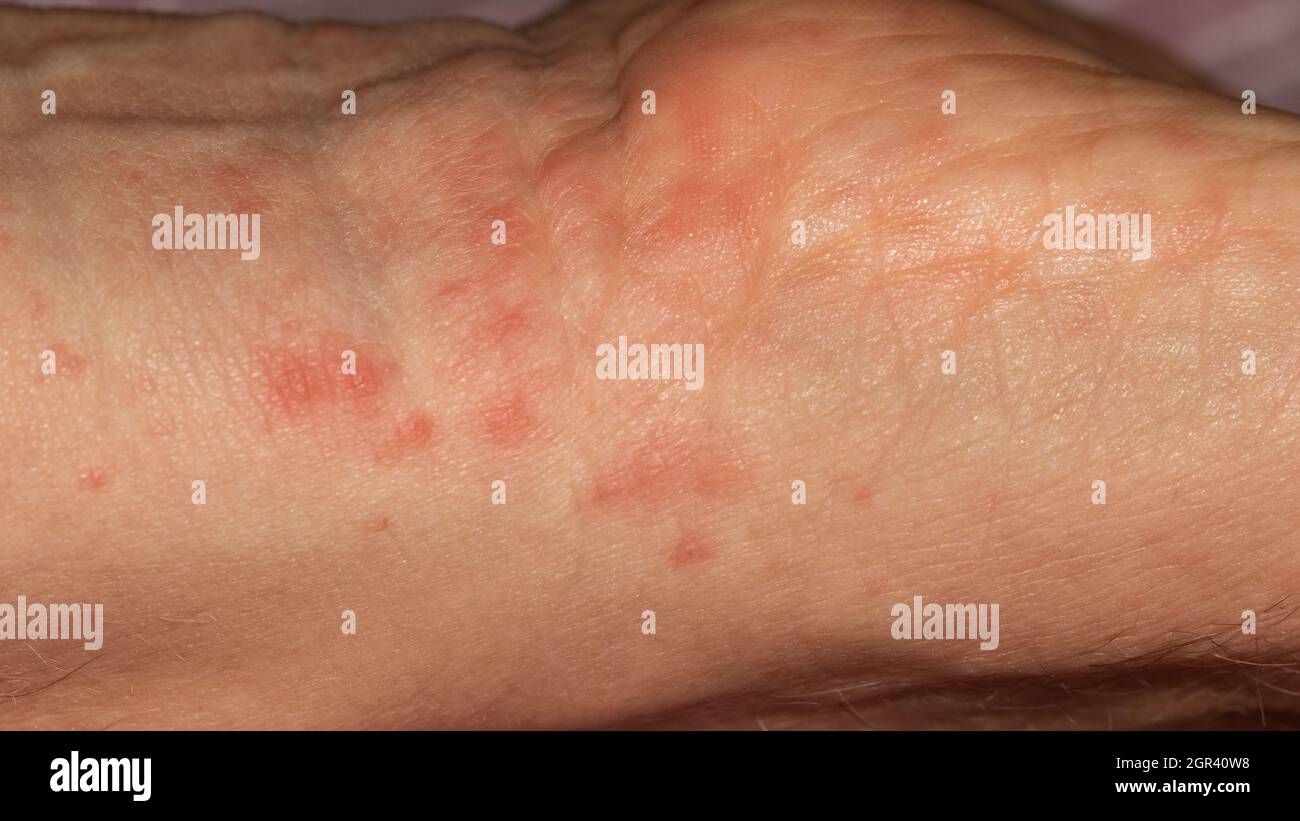 644 Scarlet Fever Images, Stock Photos, 3D objects, & Vectors