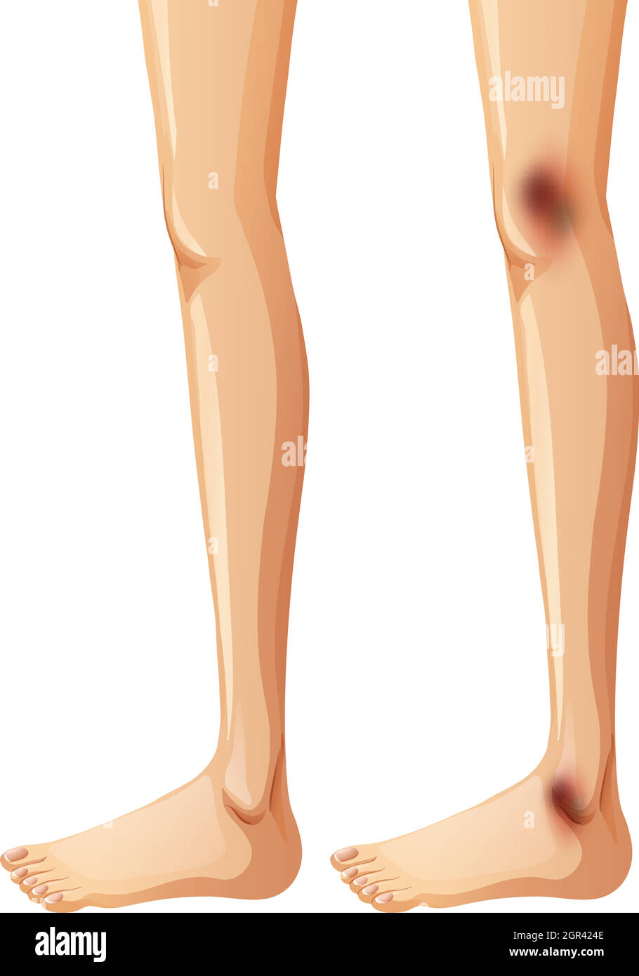 Human Legs and Bruise on White Background Stock Vector