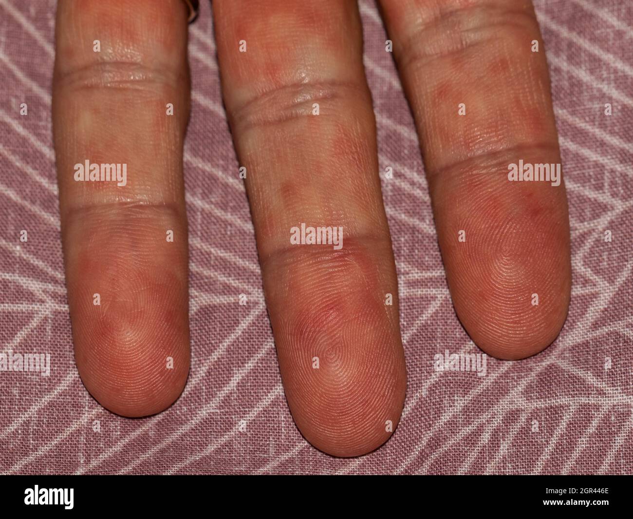 dermatology infection on adult man, scarlet fever Stock Photo