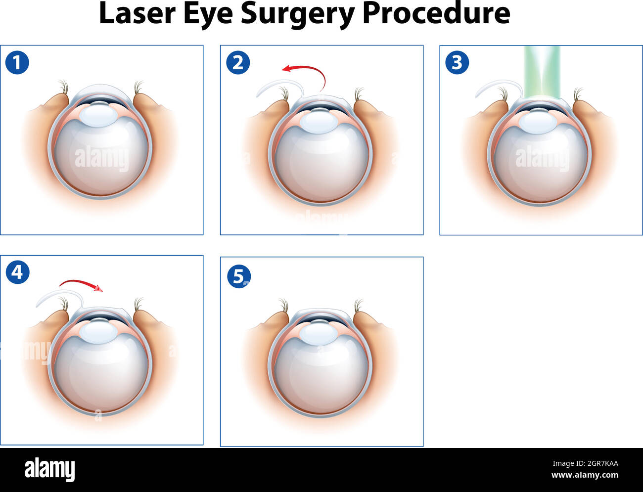 Laser Eye Surgery Procedure Stock Vector