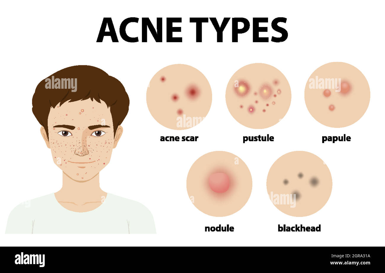 Types of acne on the skin or pimples Stock Vector