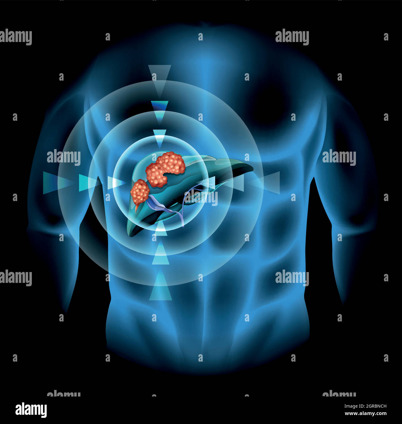Liver Cancer Diagram Showing Details Stock Vector Image And Art Alamy 6437