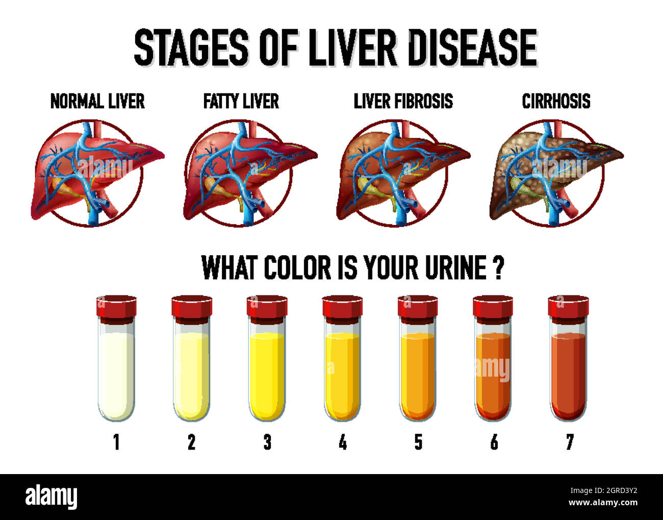 Stages of liver disease Stock Vector Image & Art - Alamy