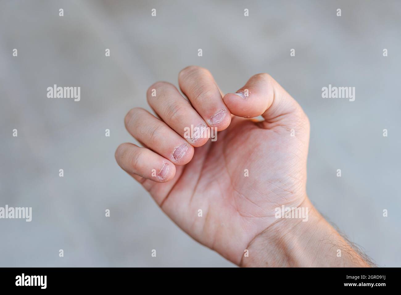 A Man's Hand With Bitten And Ugly Fingernails. Bad Care Of Hands Stock