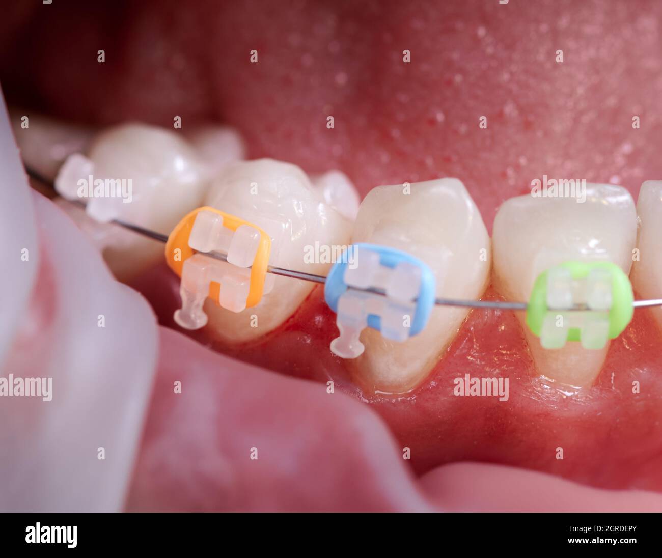 Closeup snapshot of a few lower teeth in mouth during procedure of