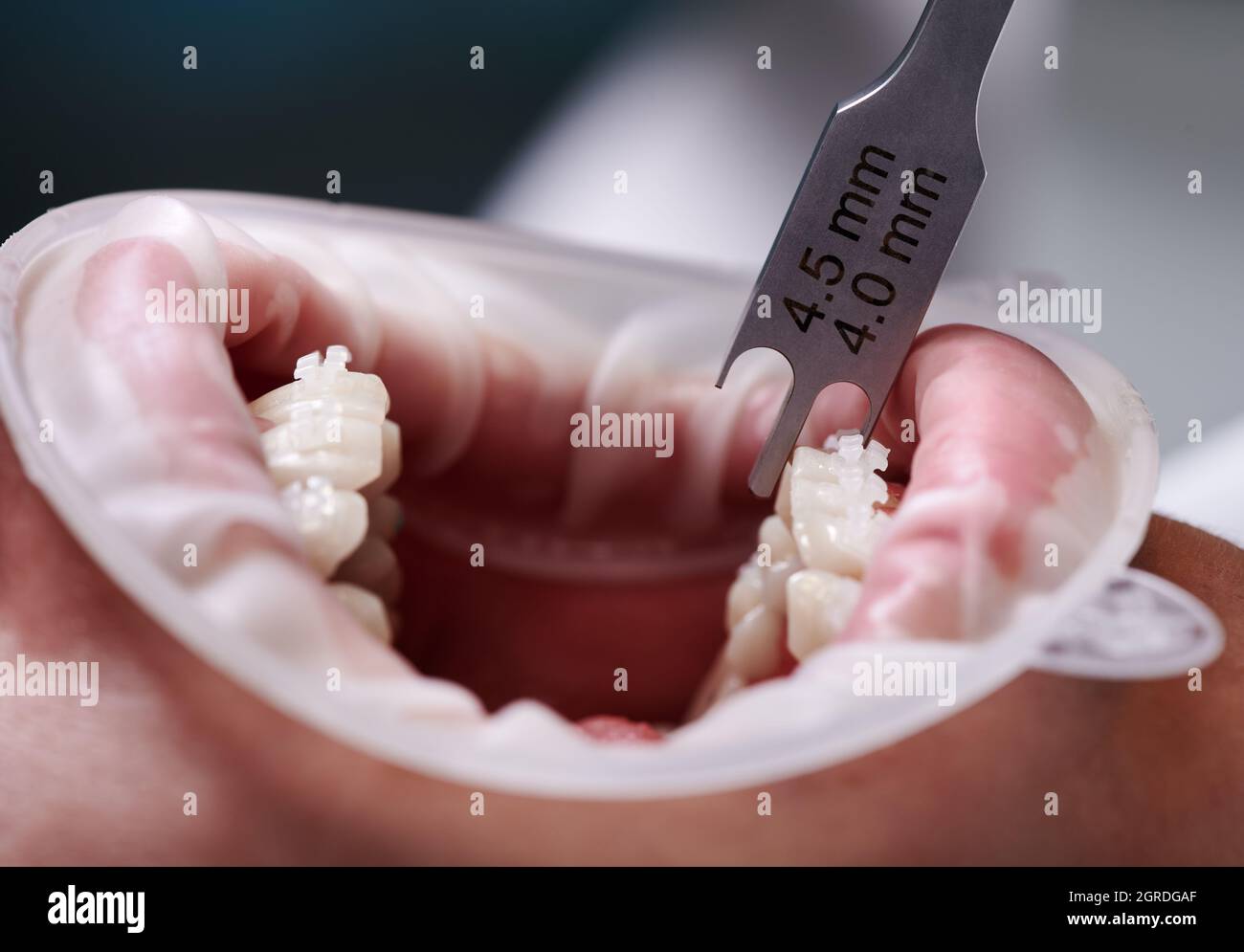 Close up of dentist using aluminum bracket gauge while attaching braces to patient teeth. Person