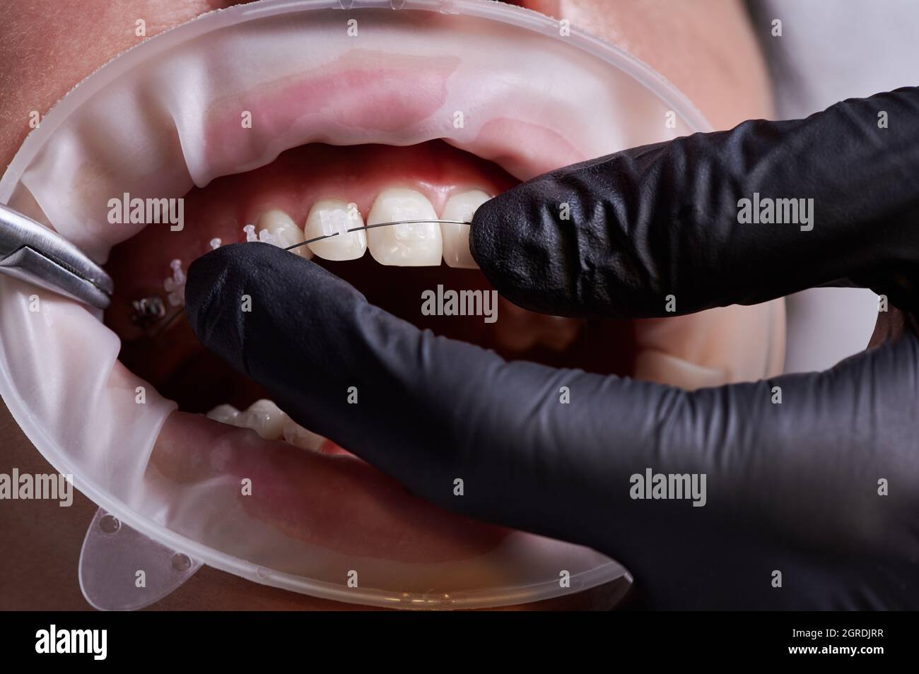 Close up view on dentist in black gloves taking off black rubber bands from  ceramic braces with a help of dental hook to replace rusty wire which  connects the braces. Concept of