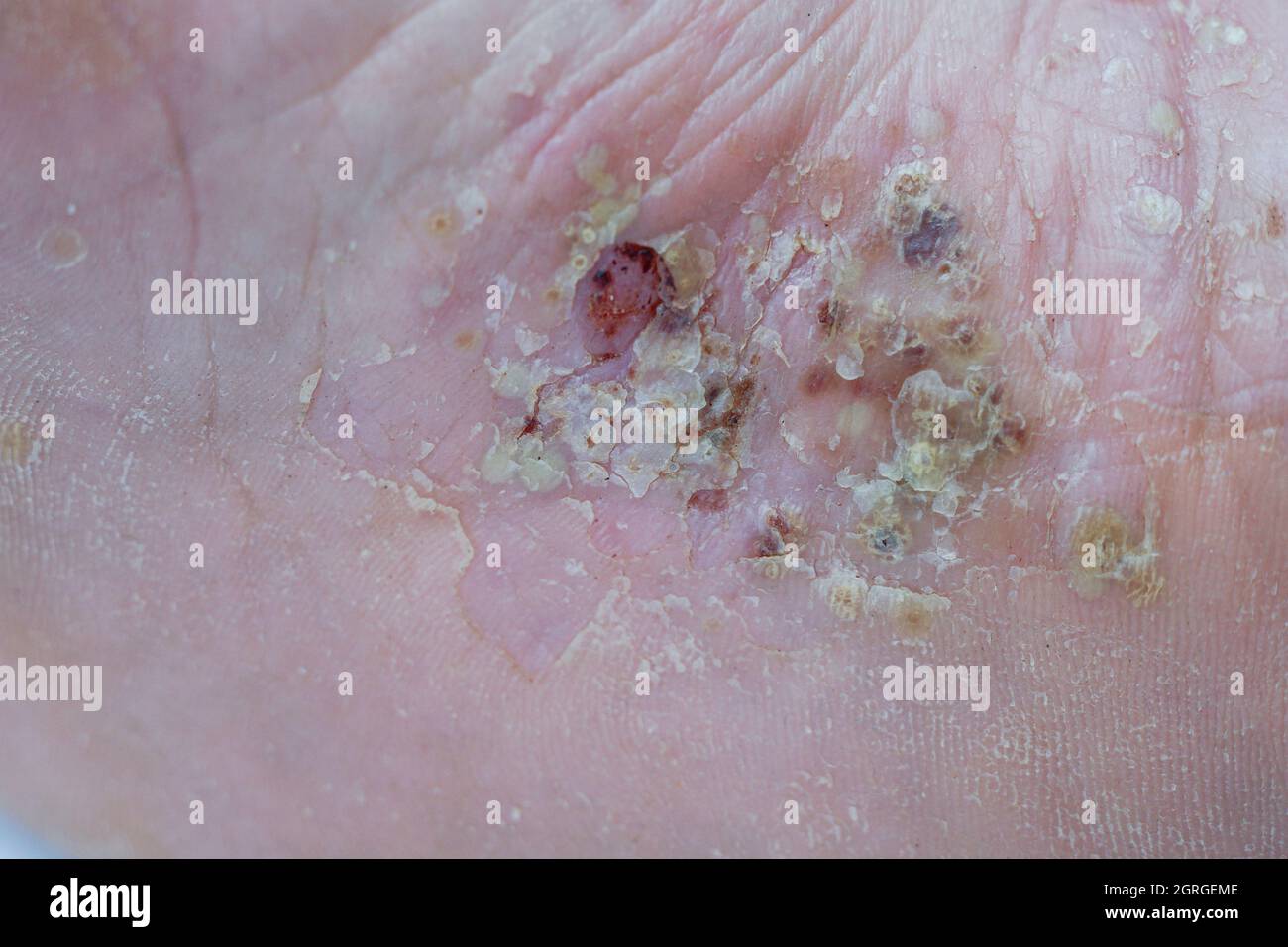 severe pustular psoriasis lesions on  the sole of the foot Stock Photo
