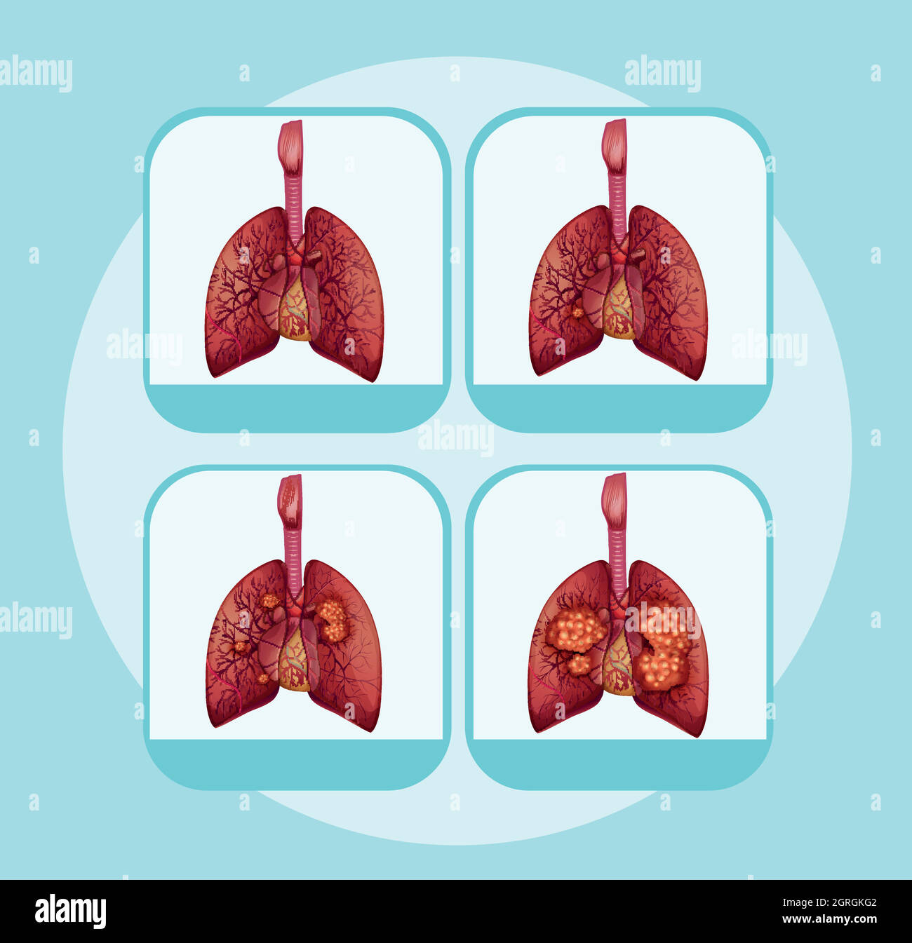 Different Stages Of Lung Cancer