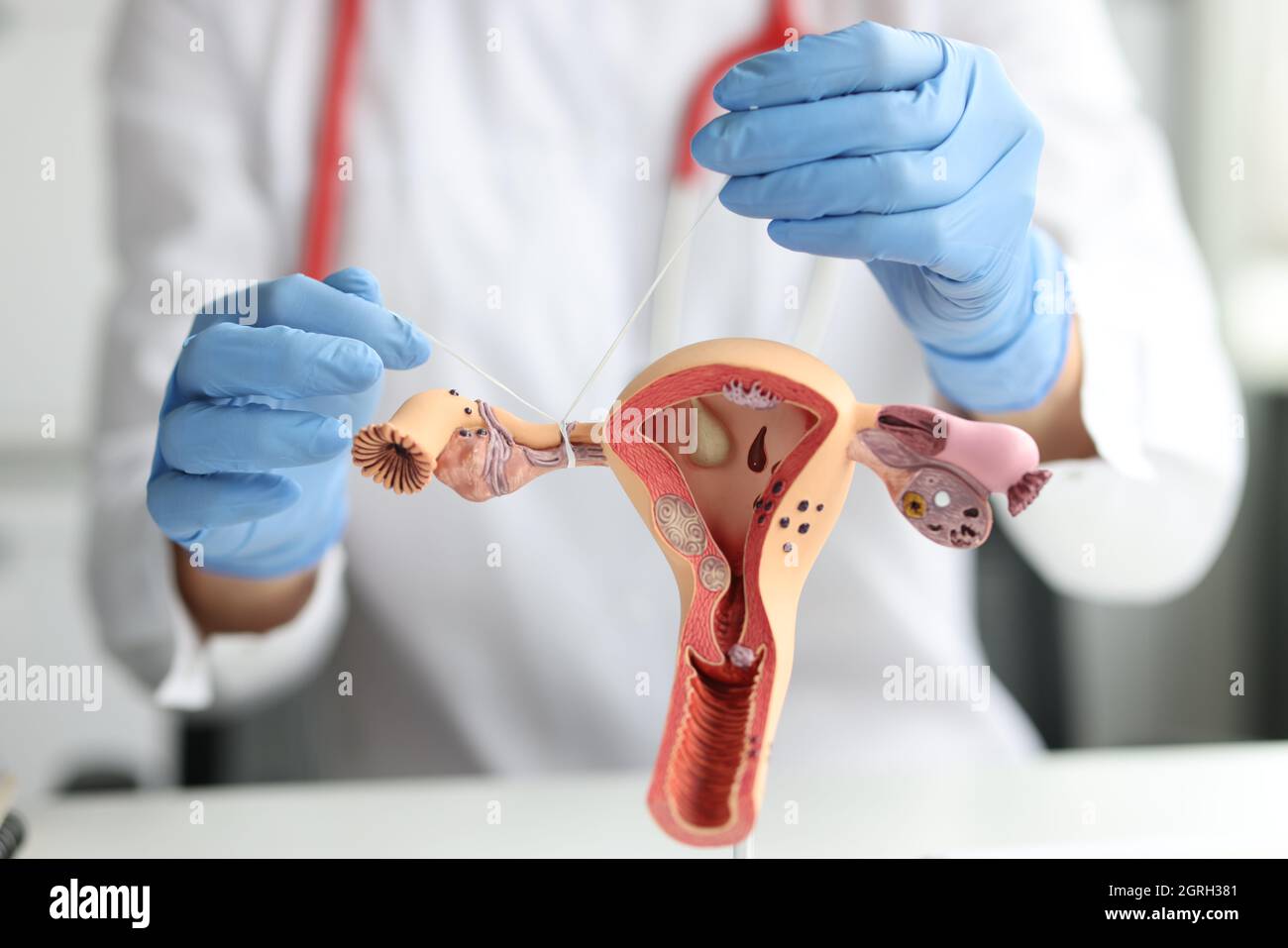 Removal of fallopian tubes hires stock photography and images Alamy