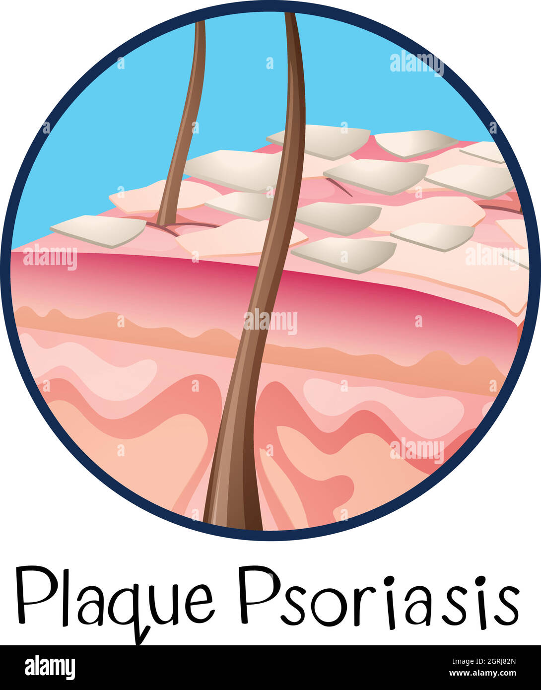 A Human Anatomy Plaque Psoriasis Stock Vector Image & Art Alamy