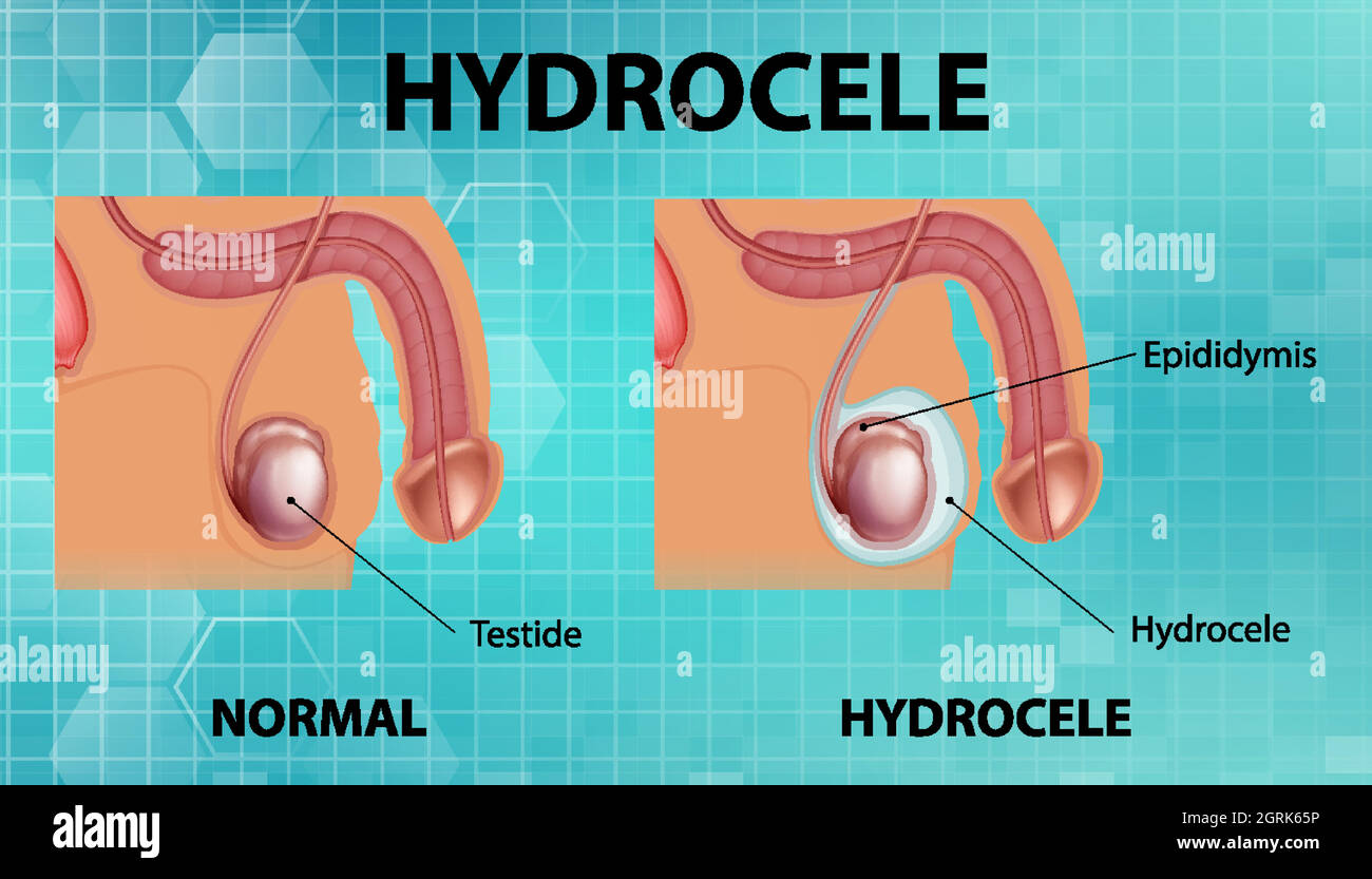 Medical poster showing different between male normal testicle and hydrocele Stock Vector
