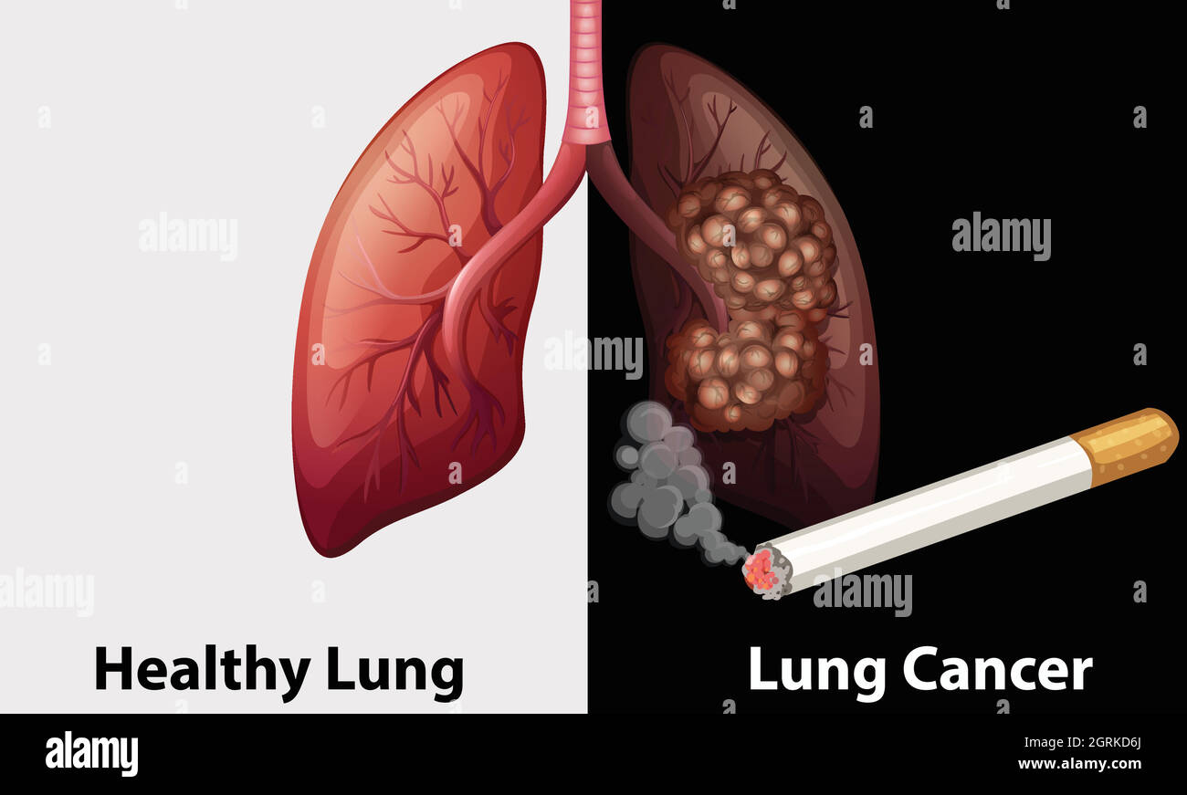 Healthy lung against lung cancer diagram Stock Vector