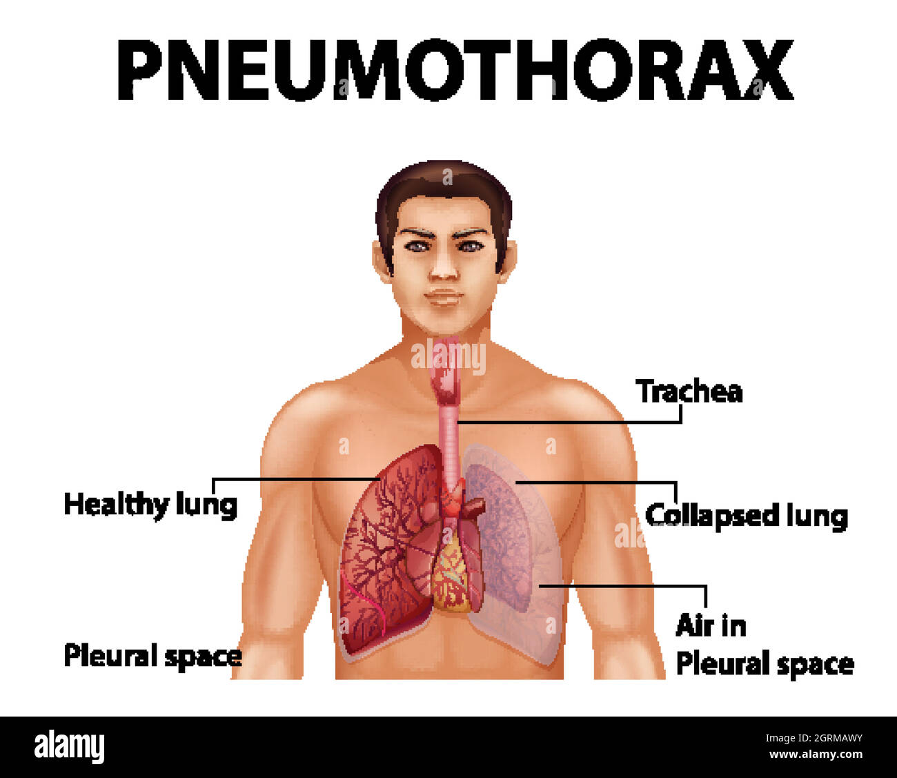Informative illustration of Pneumothorax Stock Vector