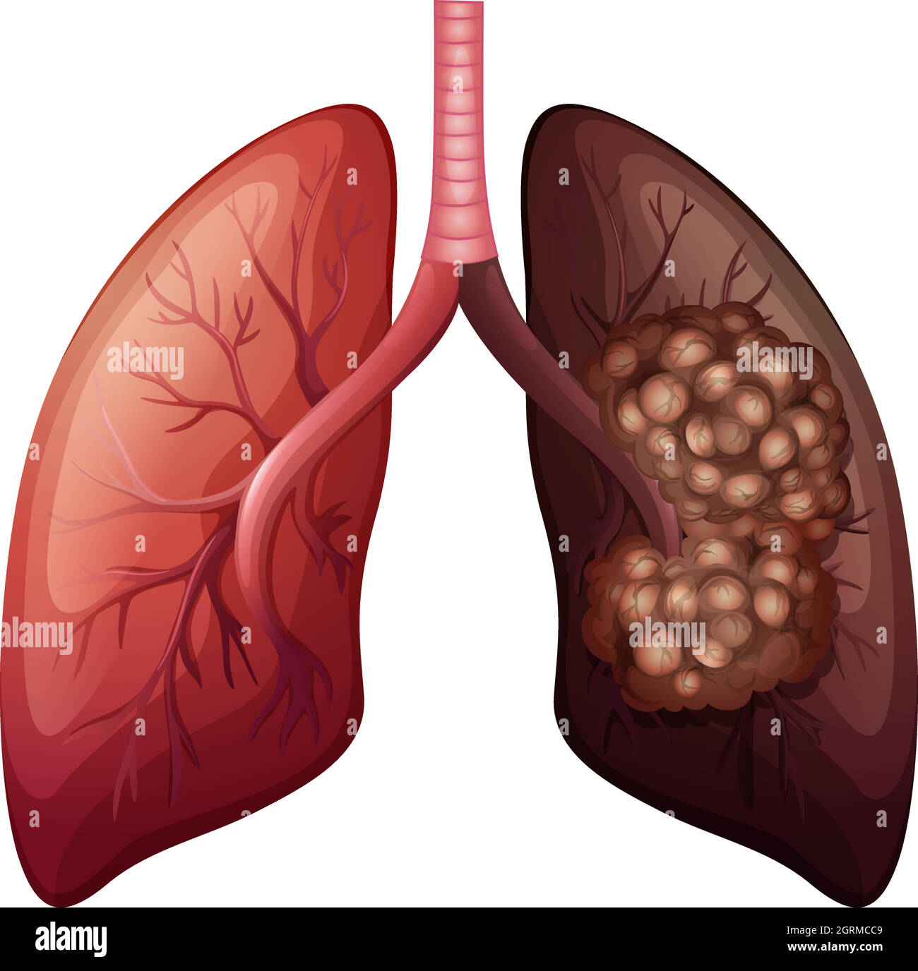 Normal lung and lung cancer Stock Vector